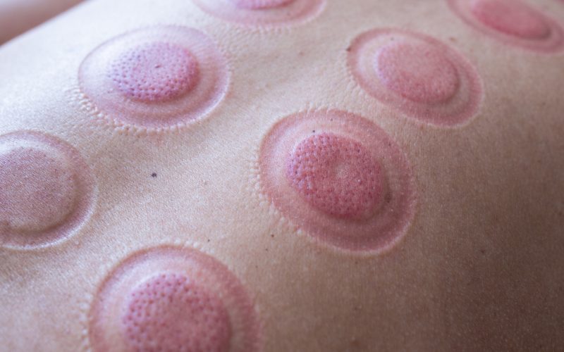 A man back with blood marks massaged after taking Chinese cupping therapy